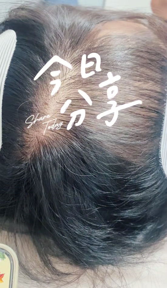 最近增发发的少 其实每天增发客户真的很多 今天4组 眼睛酸(-^□^-) 不过看到你们头发多了 还是老开心了