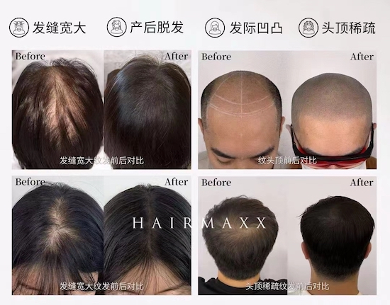 HAIRMAXX一站式“顶上”管理 一般都是会根据客户的实际情况和需求来规划和提出方案