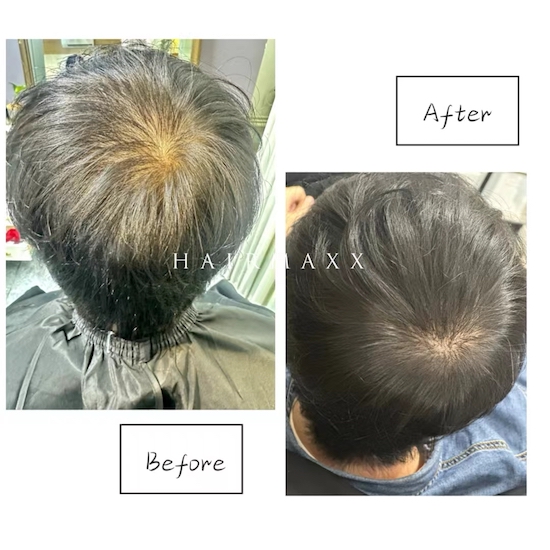 春节过后的“发量管理”您做好了吗？ 不是染发 · 不是植发 · 不是药物 是“物理增发”